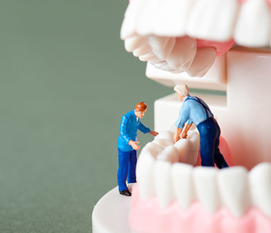 すきっ歯の治療